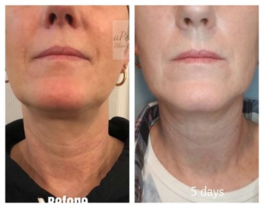 The HIFU Neck Treatment Photo